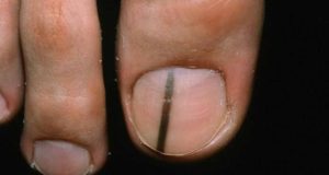 ¡Una línea negra en la uña podría ser un síntoma de un tumor!
