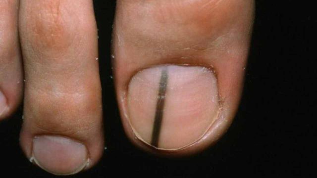 ¡Una línea negra en la uña podría ser un síntoma de un tumor!